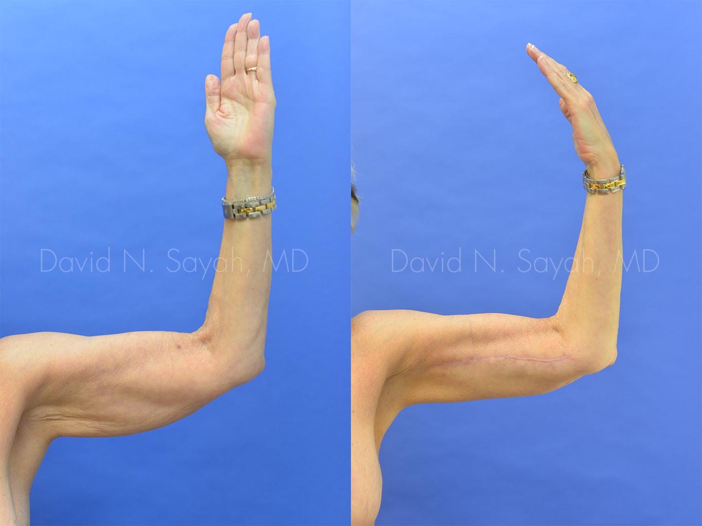 Brachioplasty Before and After | Sayah Institute