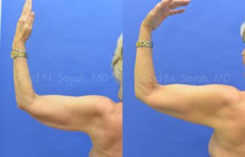 Brachioplasty Before and After | Sayah Institute
