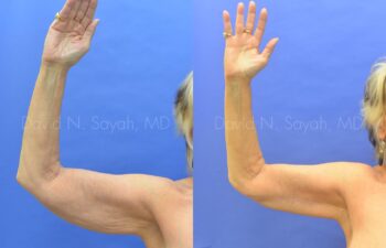 Brachioplasty Before and After | Sayah Institute