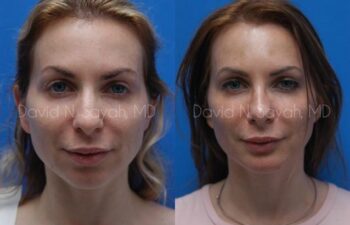 Fat Injection Face Before and After | Sayah Institute