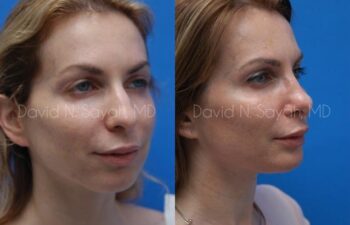 Fat Injection Face Before and After | Sayah Institute
