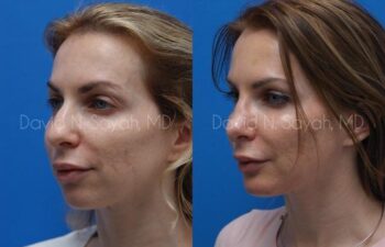 Fat Injection Face Before and After | Sayah Institute