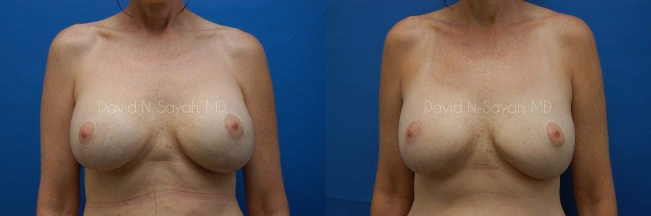 Fat Injection Breast Before and After | Sayah Institute