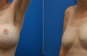 Fat Injection Breast Before and After | Sayah Institute