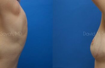 Fat Injection Breast Before and After | Sayah Institute