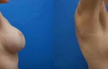 Fat Injection Breast Before and After | Sayah Institute