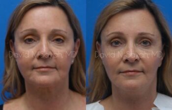 Fat Injection Face Before and After | Sayah Institute