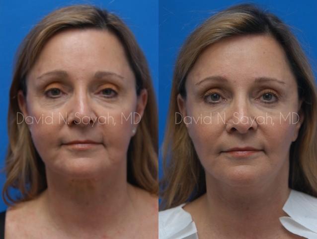Fat Injection Face Before and After | Sayah Institute