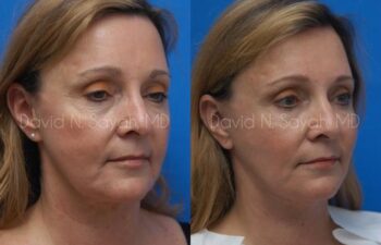 Fat Injection Face Before and After | Sayah Institute