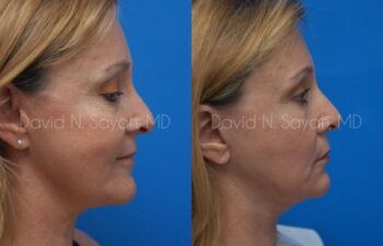 Fat Injection Face Before and After | Sayah Institute