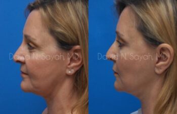 Fat Injection Face Before and After | Sayah Institute