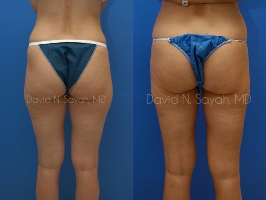 Gluteal Augmentation Before and After | Sayah Institute