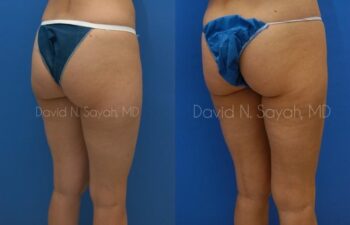 Gluteal Augmentation Before and After | Sayah Institute
