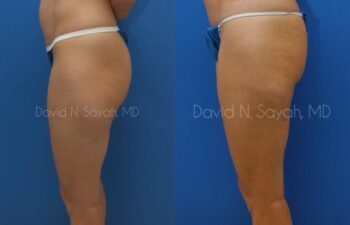 Gluteal Augmentation Before and After | Sayah Institute