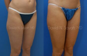 Gluteal Augmentation Before and After | Sayah Institute