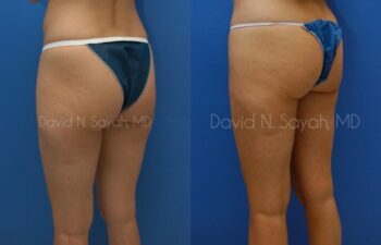 Gluteal Augmentation Before and After | Sayah Institute