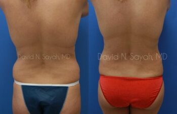 Gluteal Augmentation Before and After | Sayah Institute