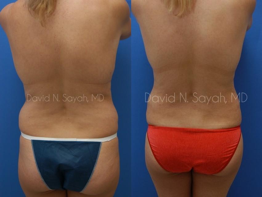 Gluteal Augmentation Before and After | Sayah Institute