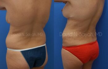 Gluteal Augmentation Before and After | Sayah Institute