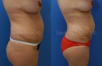 Gluteal Augmentation Before and After | Sayah Institute