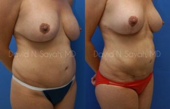 Gluteal Augmentation Before and After | Sayah Institute
