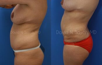 Gluteal Augmentation Before and After | Sayah Institute