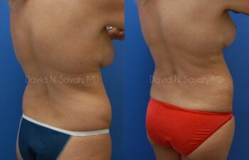 Gluteal Augmentation Before and After | Sayah Institute