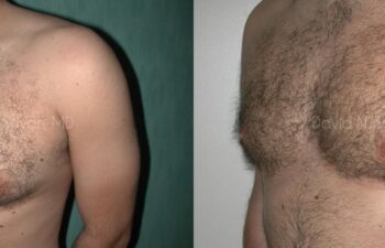 Male Breast Surgery Before and After | Sayah Institute