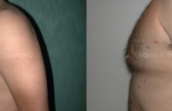Male Breast Surgery Before and After | Sayah Institute