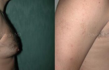 Male Breast Surgery Before and After | Sayah Institute
