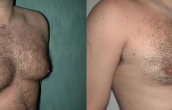 Male Breast Surgery Before and After | Sayah Institute
