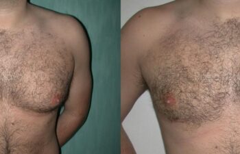 Male Breast Surgery Before and After | Sayah Institute