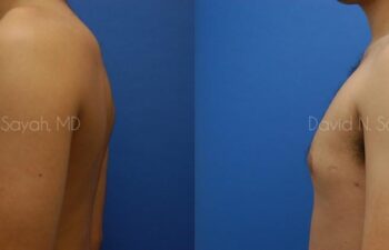Male Breast Surgery Before and After | Sayah Institute