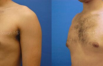 Male Breast Surgery Before and After | Sayah Institute