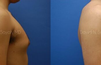 Male Breast Surgery Before and After | Sayah Institute