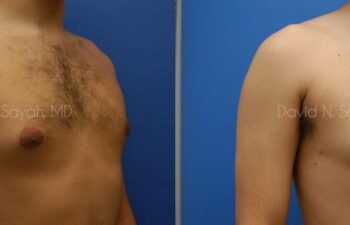 Male Breast Surgery Before and After | Sayah Institute