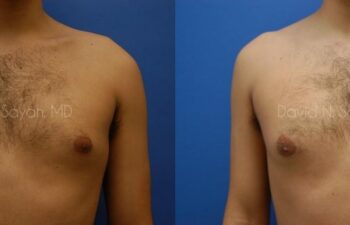 Male Breast Surgery Before and After | Sayah Institute