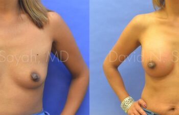 Breast Augmentation Before and After | Sayah Institute