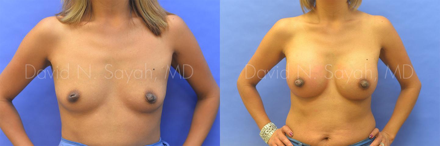 Breast Augmentation Before and After | Sayah Institute