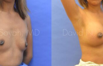 Breast Augmentation Before and After | Sayah Institute