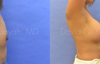 Breast Augmentation Before and After | Sayah Institute