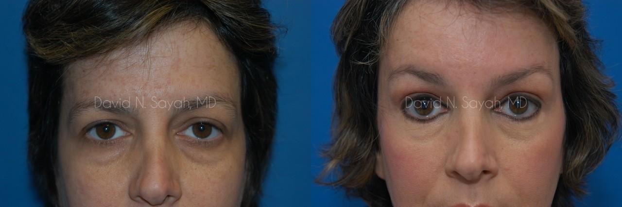 Brow Lift Before and After | Sayah Institute