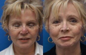 Endoscopic Brow Lift Before and After | Sayah Institute
