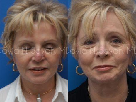 Endoscopic Brow Lift Before and After | Sayah Institute