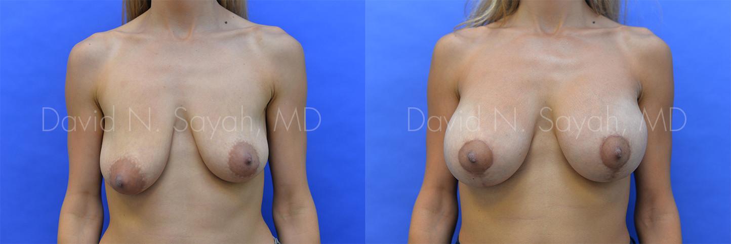 Breast Augmentation And Mastopexy Before and After | Sayah Institute