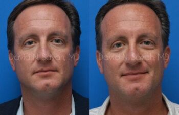 Rhinoplasty Before and After | Sayah Institute