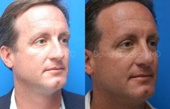 Rhinoplasty Before and After | Sayah Institute