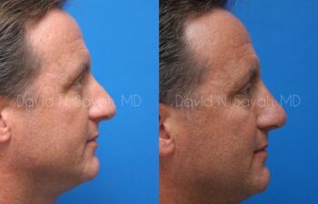 Rhinoplasty Before and After | Sayah Institute
