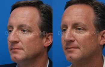 Rhinoplasty Before and After | Sayah Institute