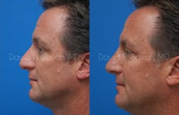 Rhinoplasty Before and After | Sayah Institute